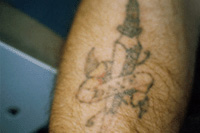 toronto tattoo removal