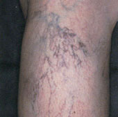 Toronto Vein Clinic - Leg Vein Removal